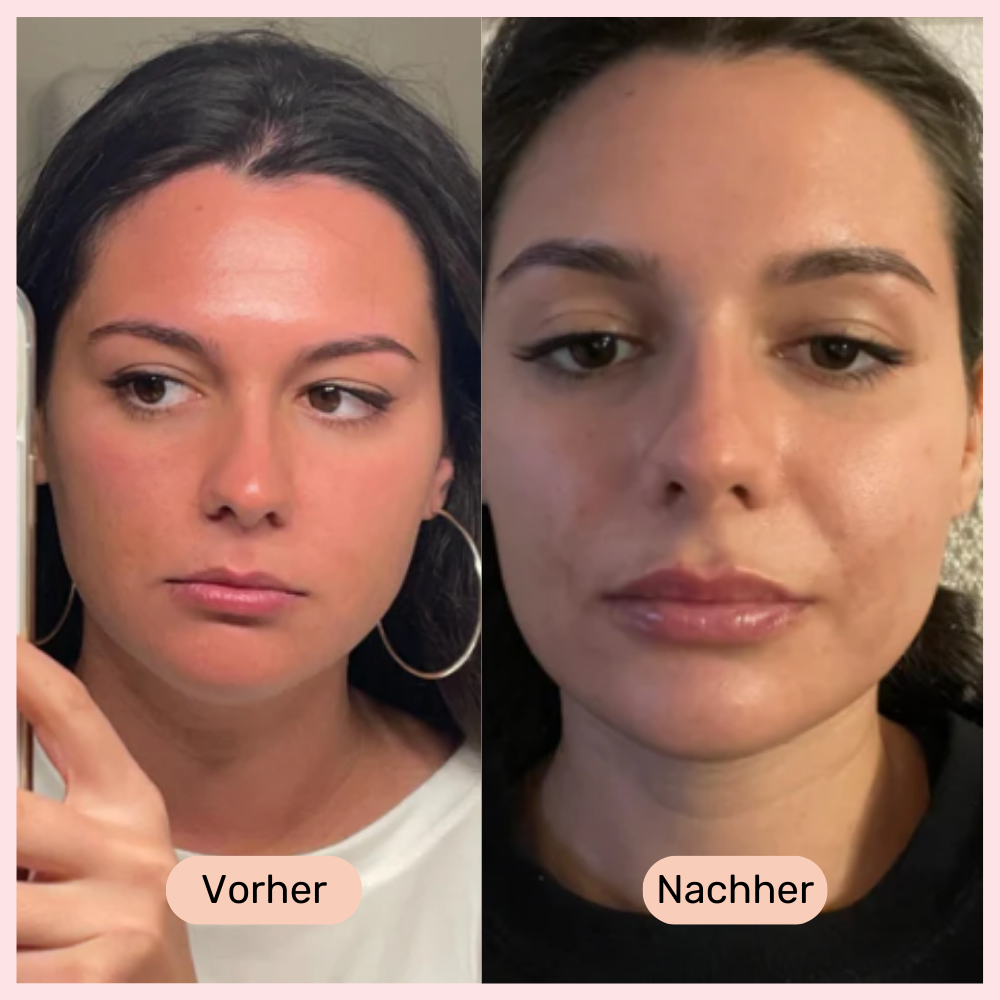 LipBooster, Natürliche Vollere Lippen